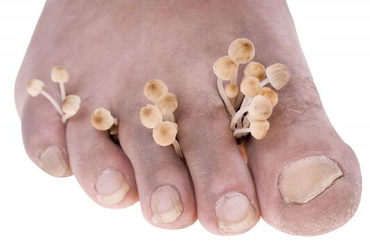 fungus on the toes