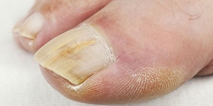 toenail fungus symptoms