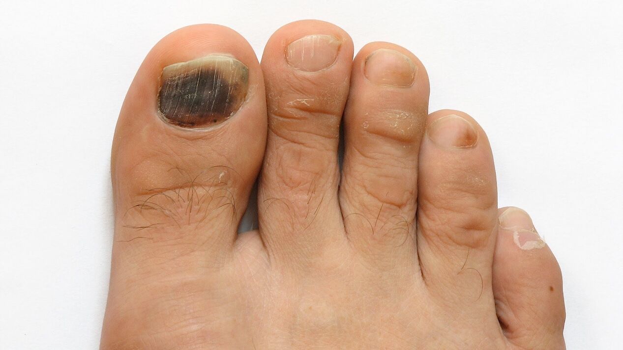 symptoms of toe fungus photo 2