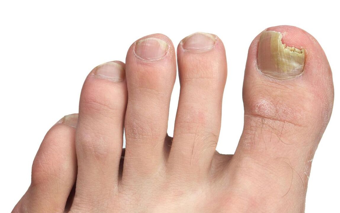 symptoms of toe fungus photo 3