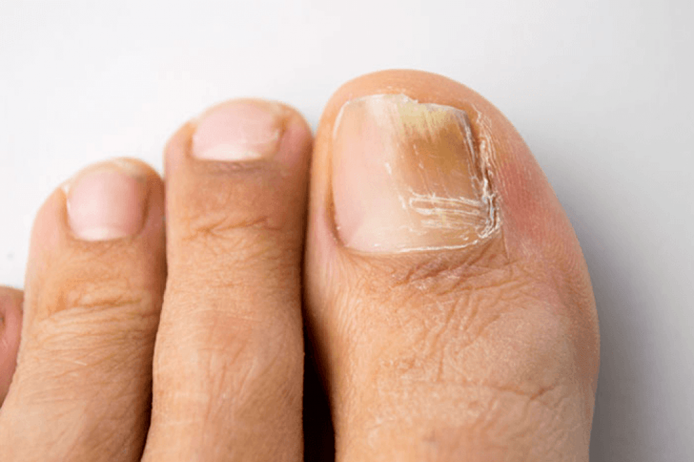 toe fungus symptoms photo 4