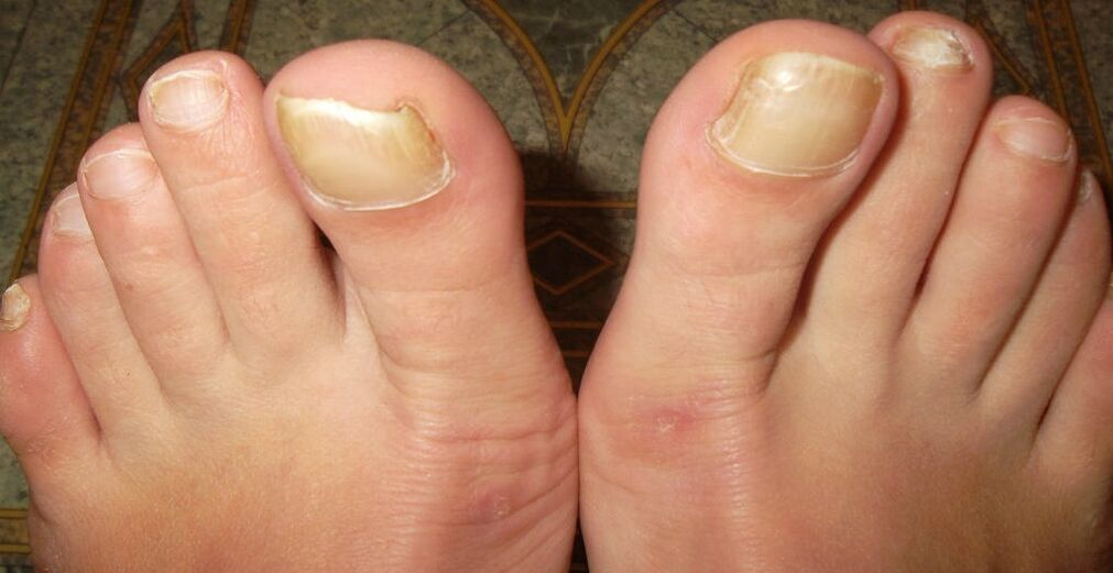 early stage of toenail fungus