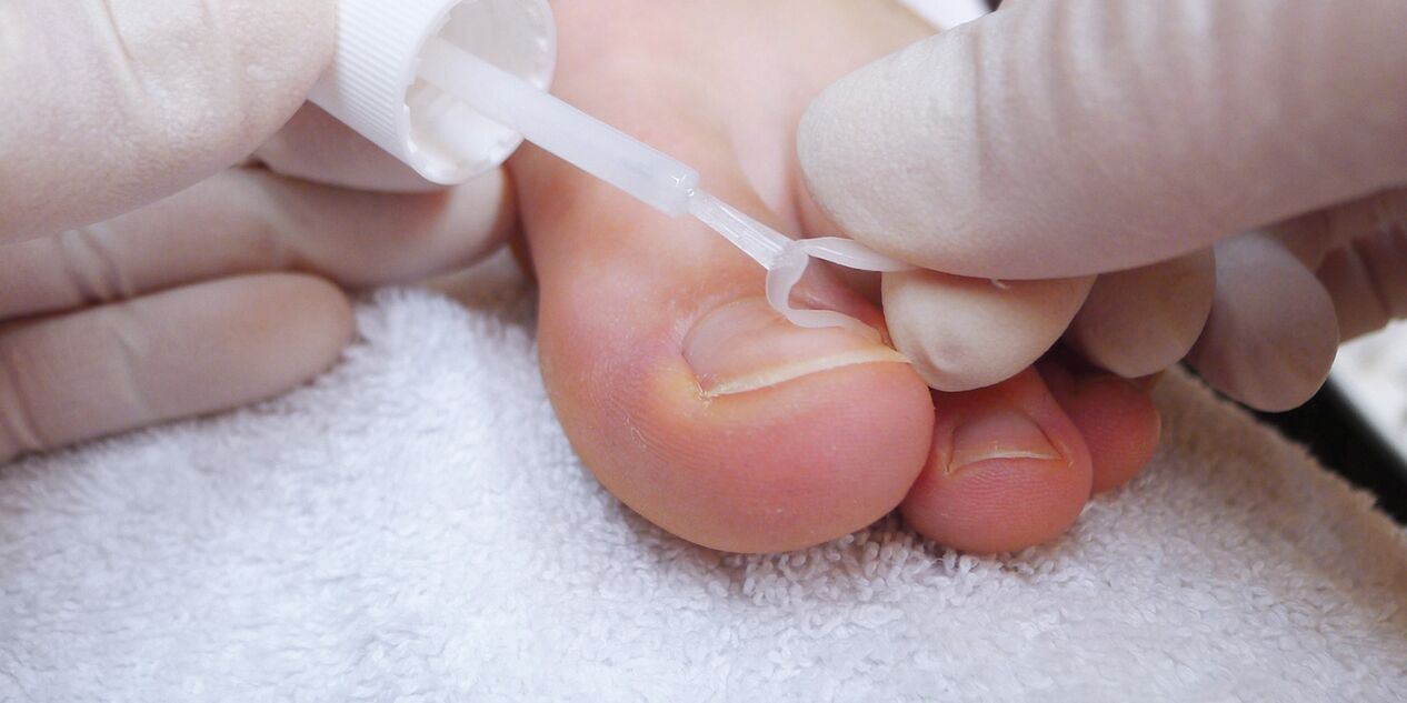 therapeutic nail polish against fungus
