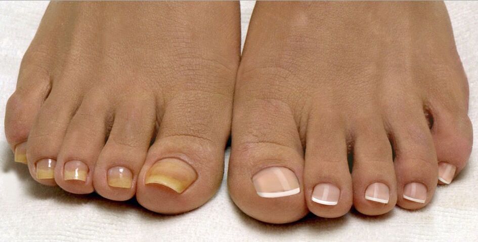 healthy toenails and toenail fungus
