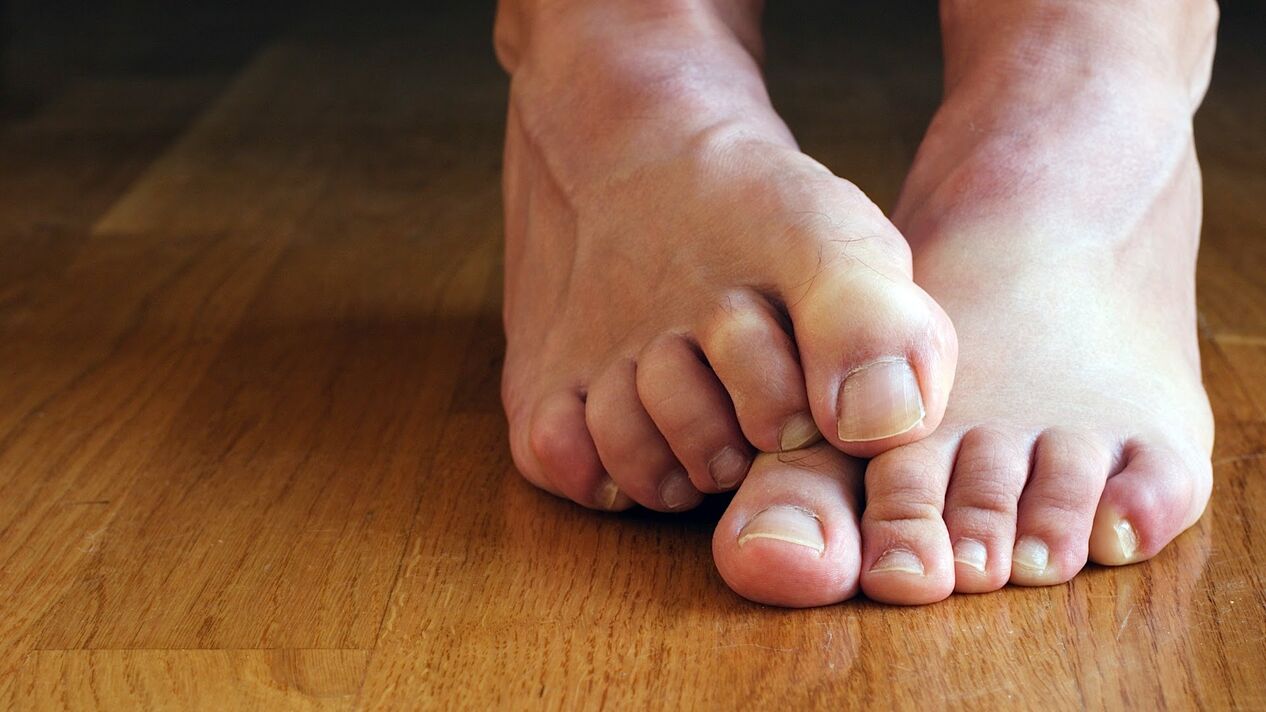 itchy skin on the feet with fungus