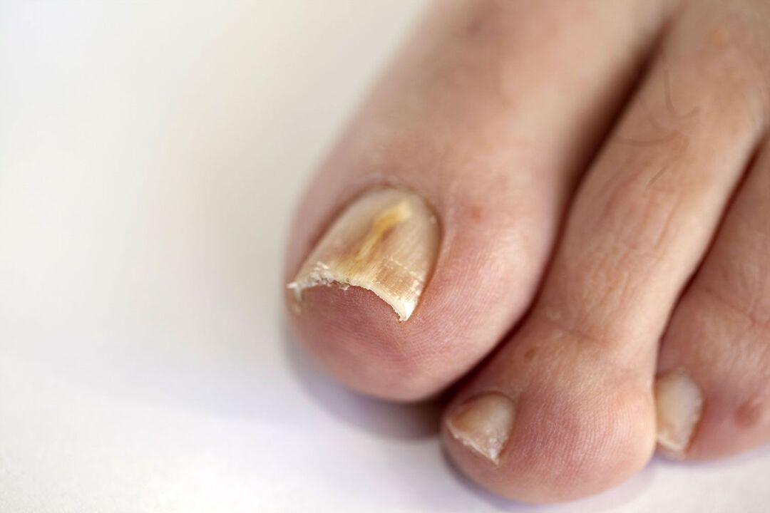 symptoms of fungus on the feet