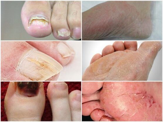 what does mycosis of the feet look like
