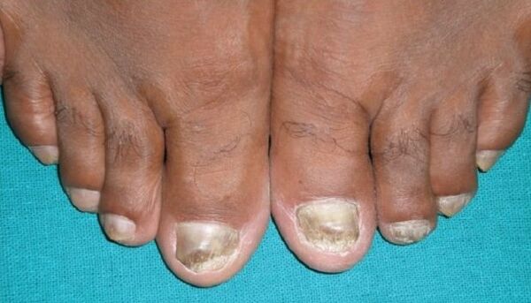 Nail fungus