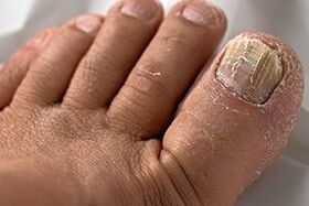 Nail fungus