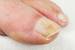 The ground -finger
