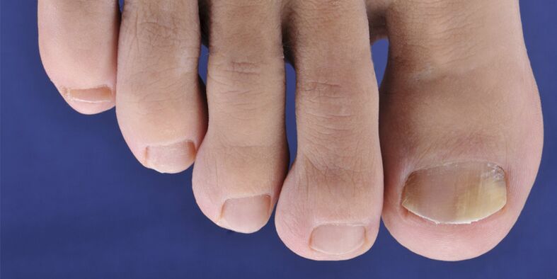 Symptoms of mycosis of the skin and nails