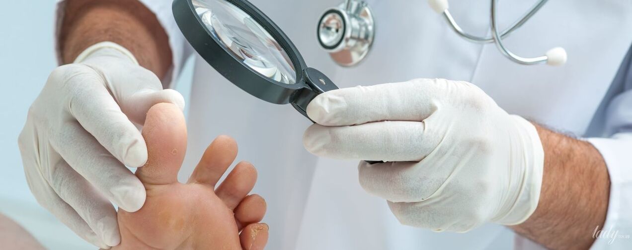 The doctor examines the fungus of the finger