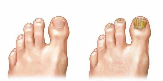 What does the nail fungus look like