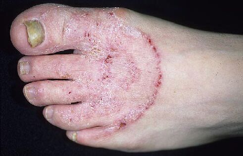 Legs and nail fungus