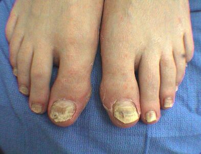 Symptoms of nail fungus