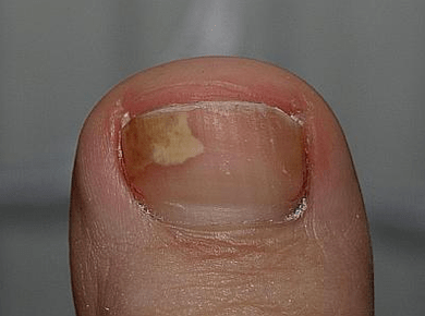fungi on the left side of the nail
