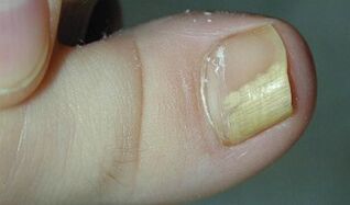 Signs and symptoms of nail fungus