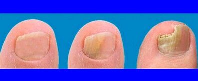 Stages of the development of fungi on the toes