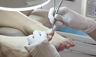 Surgical nail removal in the presence of a fungus