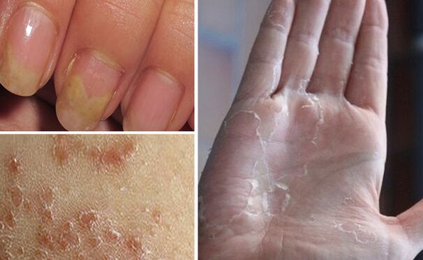 Can mycosis switch to other parts of the body
