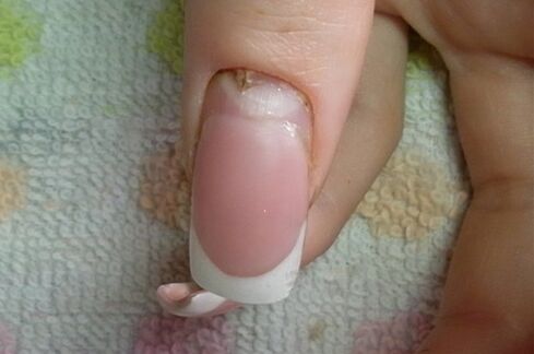 nail fungus symptoms