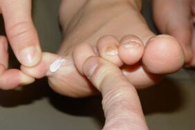 toe fungus