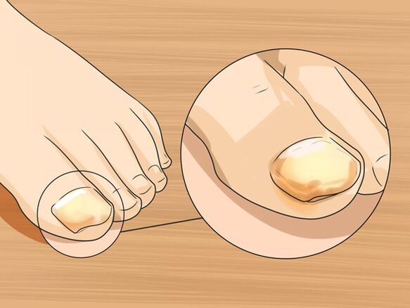 fungus of the big toe