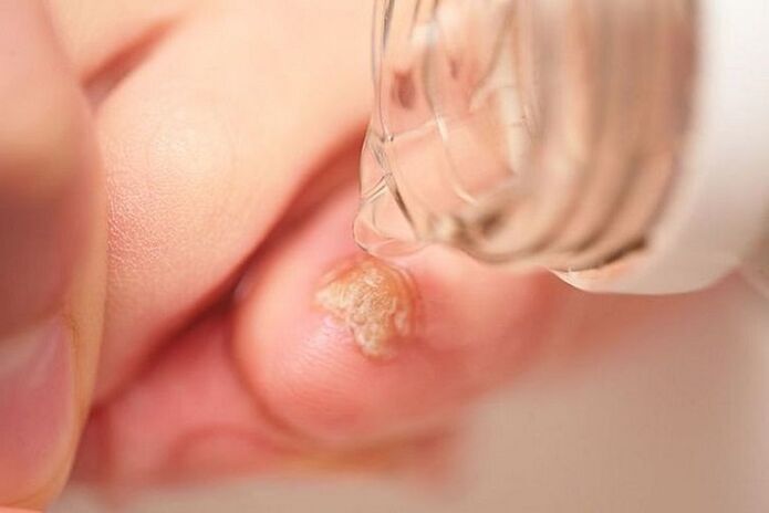 treatment of toenail fungus with vinegar