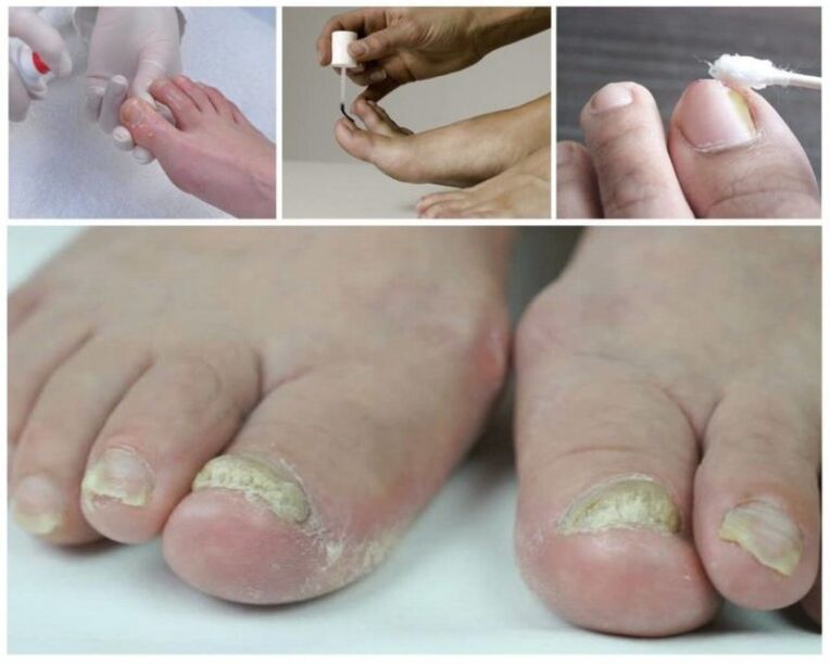 medicines for toenail fungus