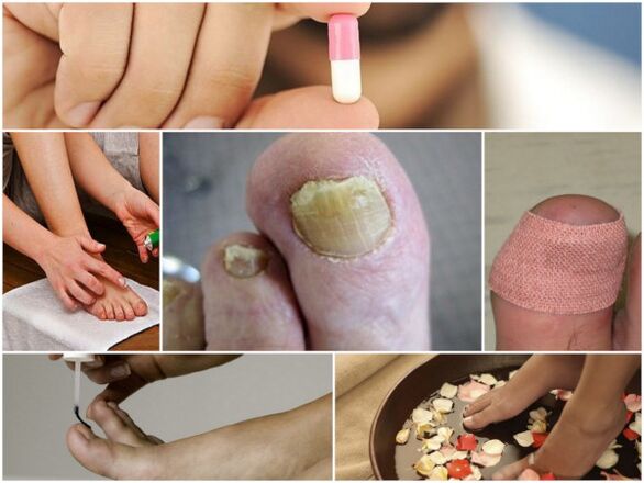 types of drugs for toenail fungus