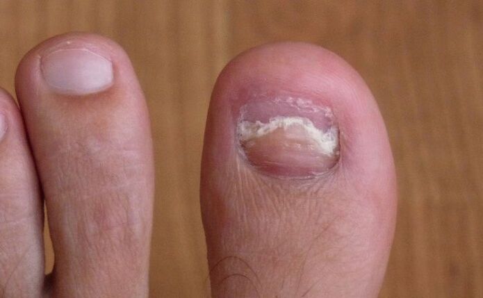 damage to the toenail with fungus