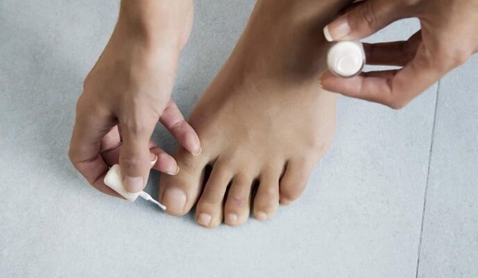 treatment of fungus on the big toe with nail polish
