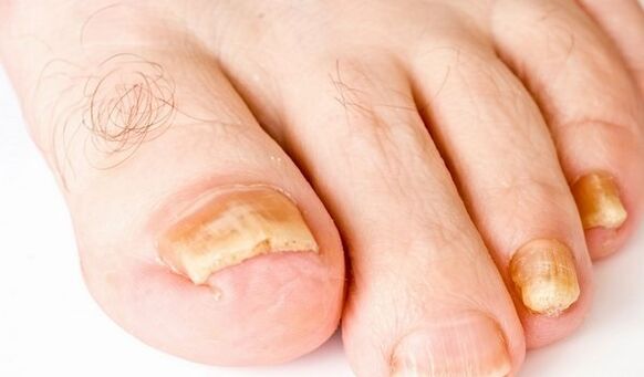 picture of symptoms of toenail fungus
