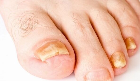yellow toenails in fungal infections