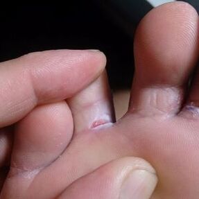 crack between the toes fungal symptoms